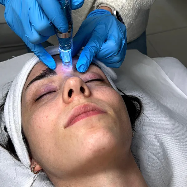 microneedling donna margotricolab
