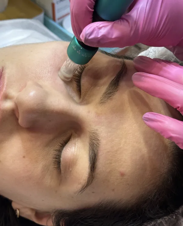 microneedling viso